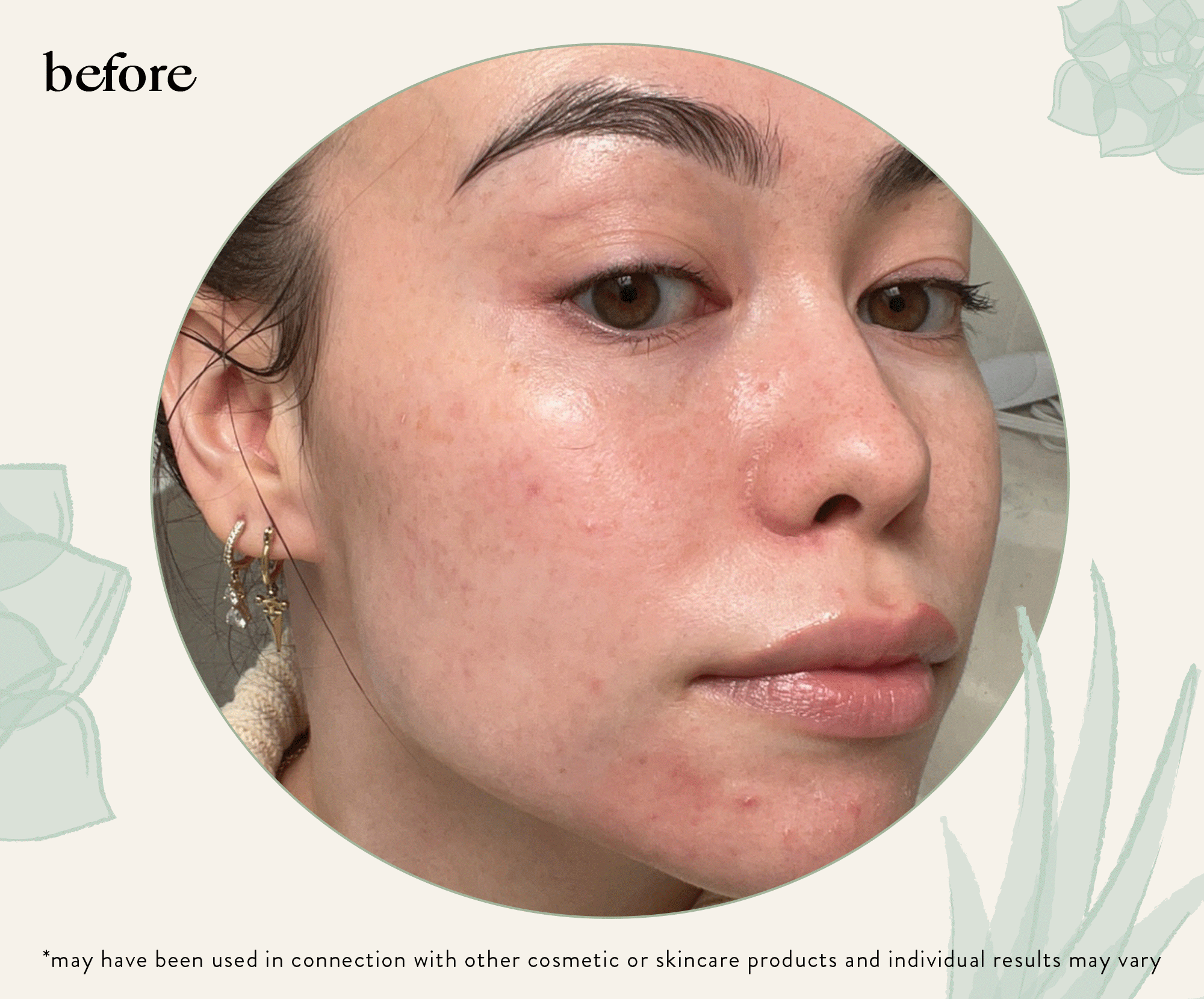 Acne Clearing Line